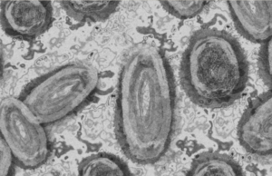 López Gatell confirma el segundo caso de viruela de mono en CDMX