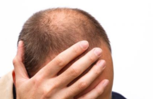 Baricitinib, el primer tratamiento contra la alopecia aprobado por la FDA