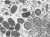 Casos de viruela del mono disminuyen a nivel mundial
