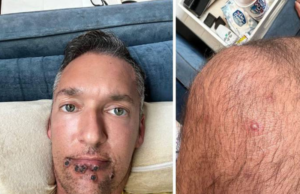 Silver Steele, estrella porno, se contagia de viruela del mono; cuenta su experiencia