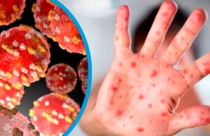 Confirman primer caso de viruela símica en Quintana Roo