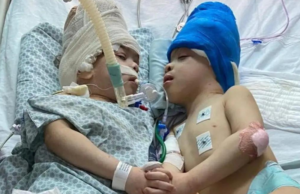 Separan a siameses unidos por la cabeza con ayuda de realidad virtual