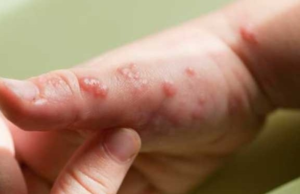 Quintana Roo mantiene tendencia a la alza en casos de Viruela Símica