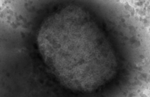 Detectan un caso de viruela del mono en Kanasín